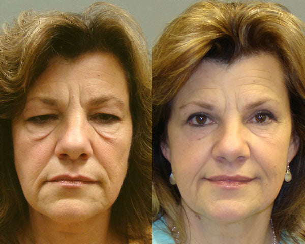 Elixr LymphaGlow Brush